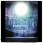 Nathan Friend broken jaw 2012 1.webp